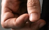 নখের পাশে চামড়া উঠলে যা করবেন