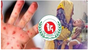 হাম ও হামের উপসর্গে শিশুমৃত্যুর সংখ্যা হাজার ছুঁই ছুঁই