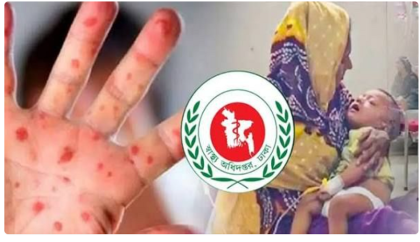 হাম ও হামের উপসর্গে শিশুমৃত্যুর সংখ্যা হাজার ছুঁই ছুঁই